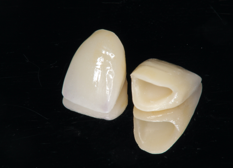 ハイブリッドセラミック|湘南パーク歯科