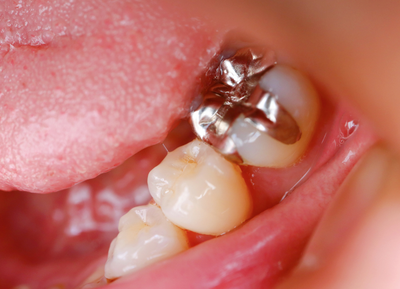 保険の銀歯に潜むリスク|湘南パーク歯科