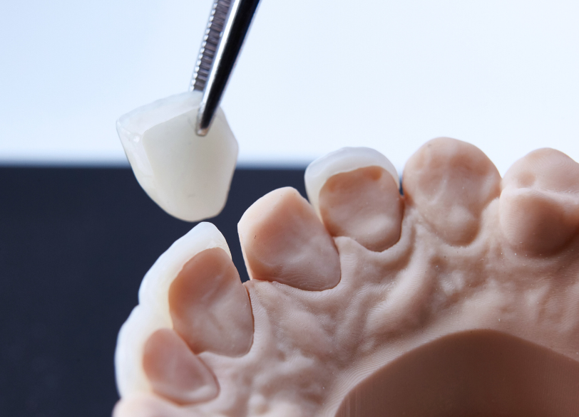 ラミネートベニア|湘南パーク歯科