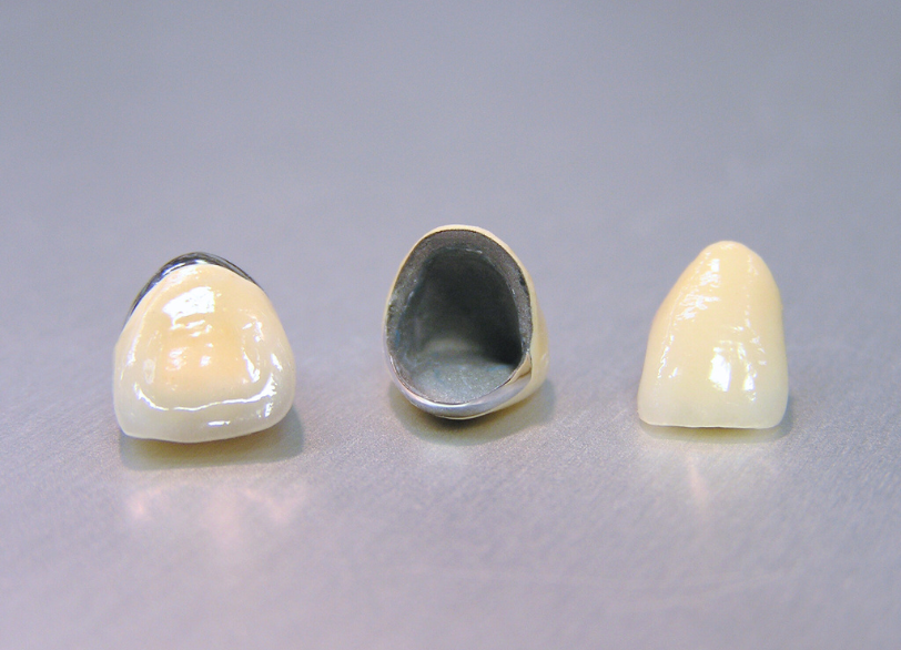 メタルボンドクラウン|湘南パーク歯科