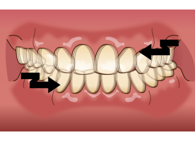 歯ぎしり｜湘南パーク歯科