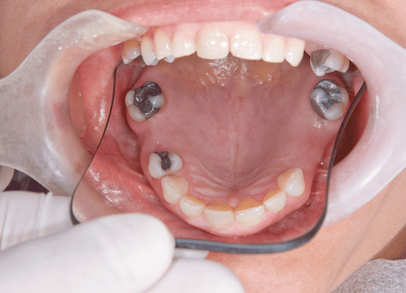 歯を失ったまま放置することのリスク｜湘南パーク歯科