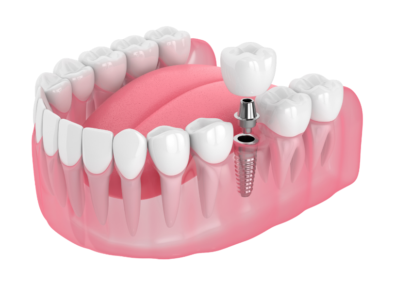 どうしても歯を失ってしまったときの最善の治療【インプラント治療】｜湘南パーク歯科