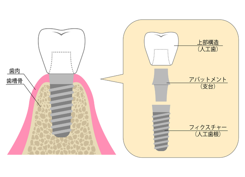 インプラントの構造と仕組み｜湘南パーク歯科
