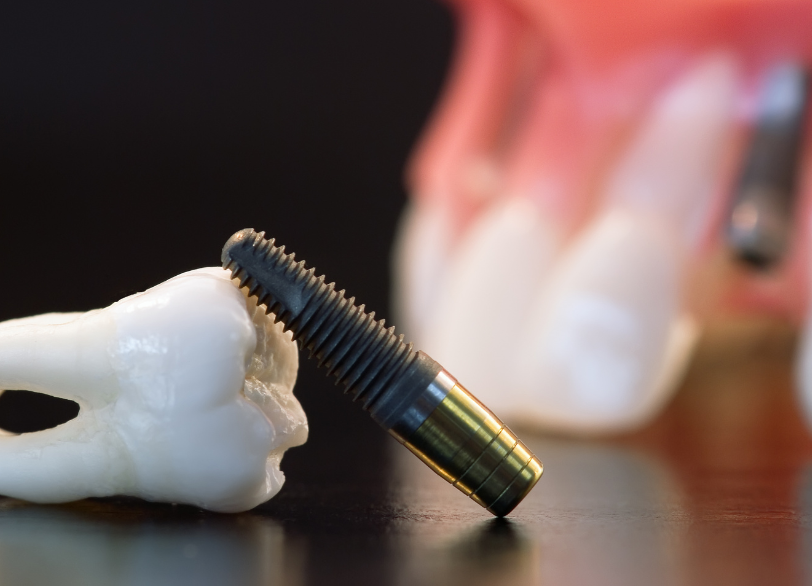 ご自身の歯と同じように噛めるインプラント治療｜湘南パーク歯科