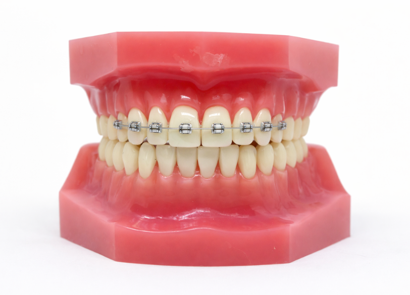 “部分矯正｜湘南パーク歯科"