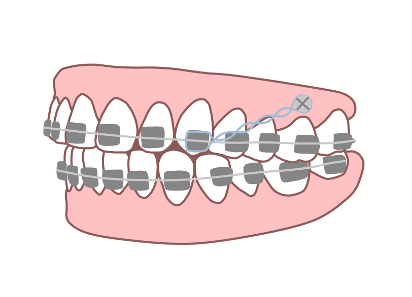 “アンカースクリュー｜湘南パーク歯科"