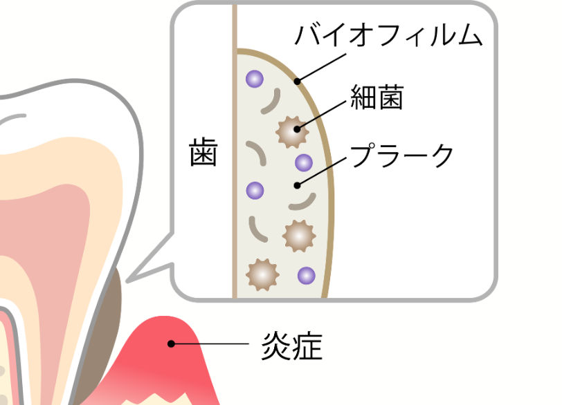 歯周病菌による感染症と破壊のメカニズム|湘南パーク歯科