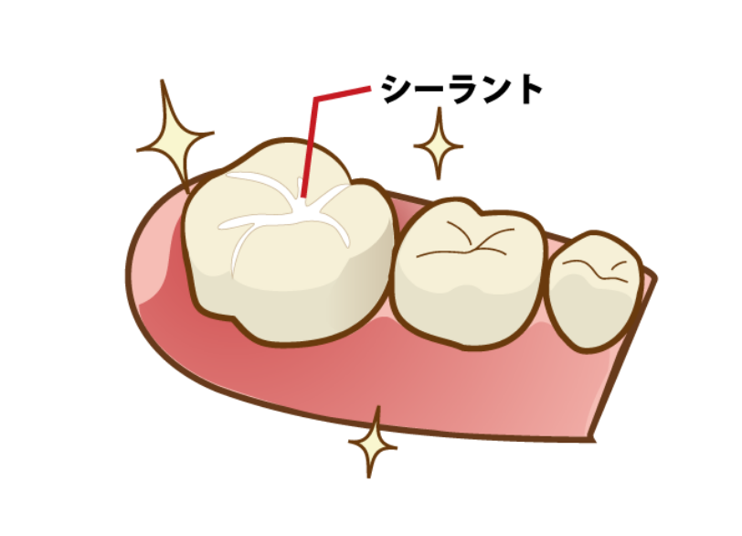 “シーラント|湘南パーク歯科"