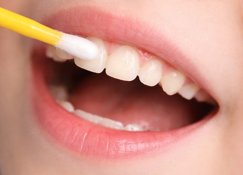 “フッ素塗布|湘南パーク歯科"