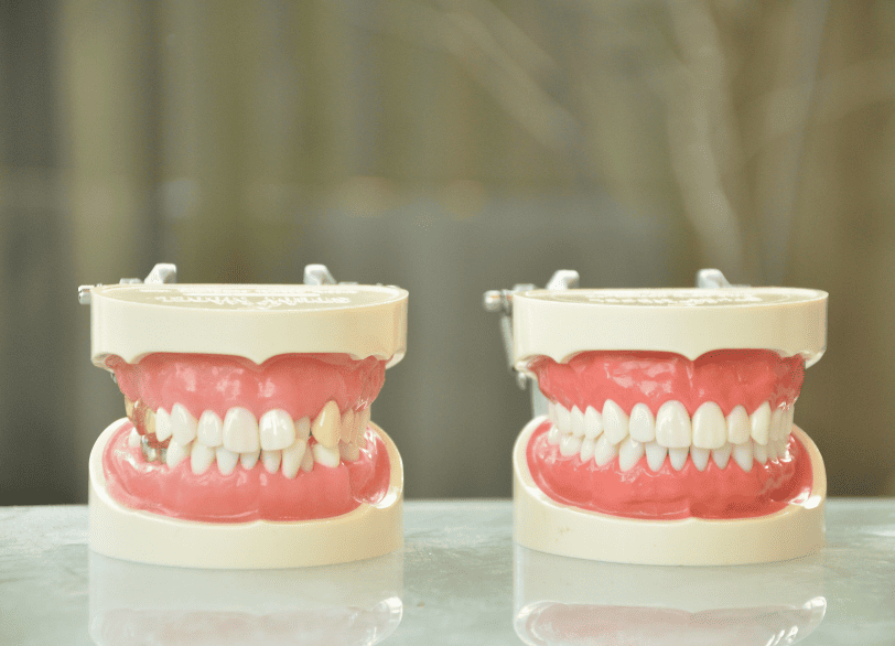 予防歯科と矯正治療の関係｜湘南パーク歯科