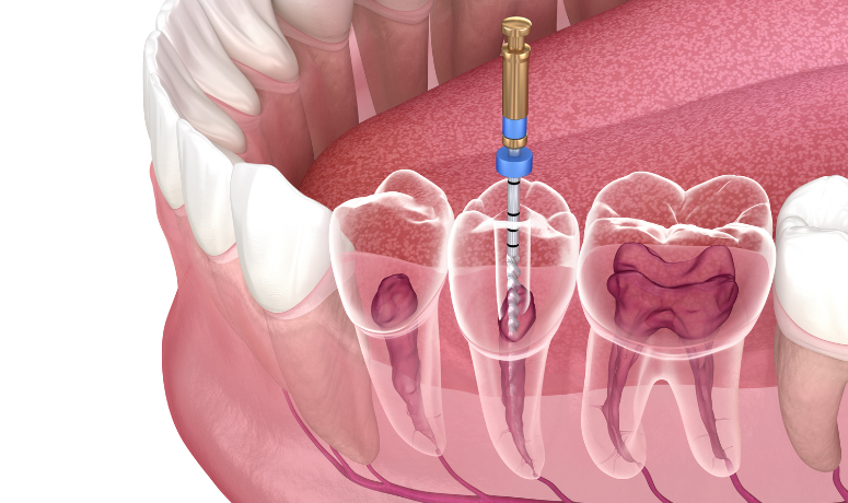 根管治療の難しさ|湘南パーク歯科