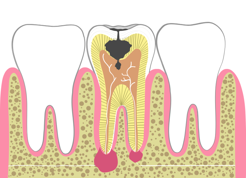 根管治療が必要になる原因|湘南パーク歯科