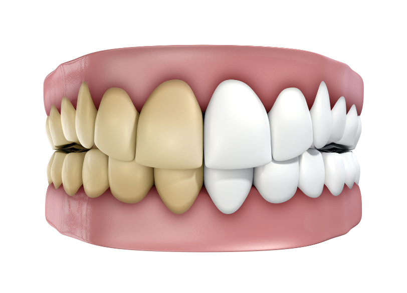 なぜ歯は黄ばむのか|湘南パーク歯科
