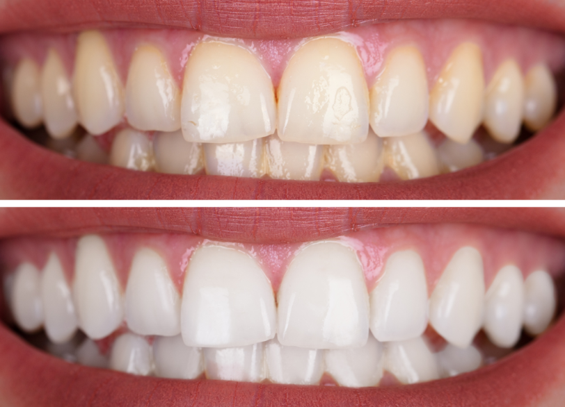 ホワイトニングの注意点|湘南パーク歯科