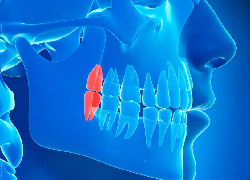 親知らずの抜歯|湘南パーク歯科